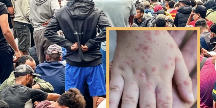 استنفار صحي في سبتة بعد إصابة قاصر مغربي بـ«جدري القردة»